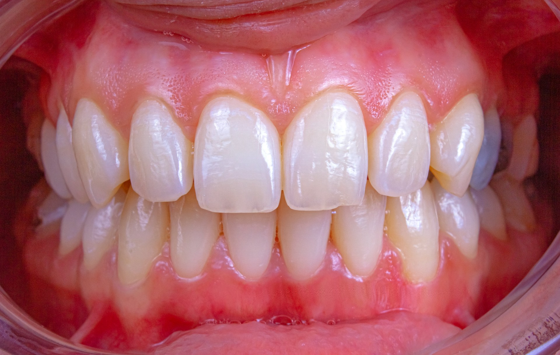 Visuel symbolisant le coût variable d'un blanchiment des dents selon la méthode et le praticien choisis.
