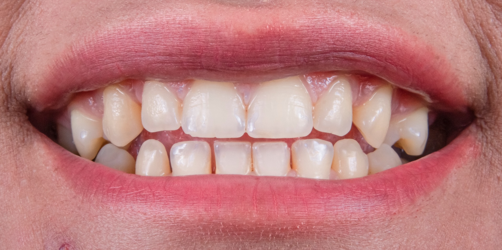Dentifrice spécifique au blanchiment des dents posé sur une brosse, à intégrer dans le rituel quotidien.