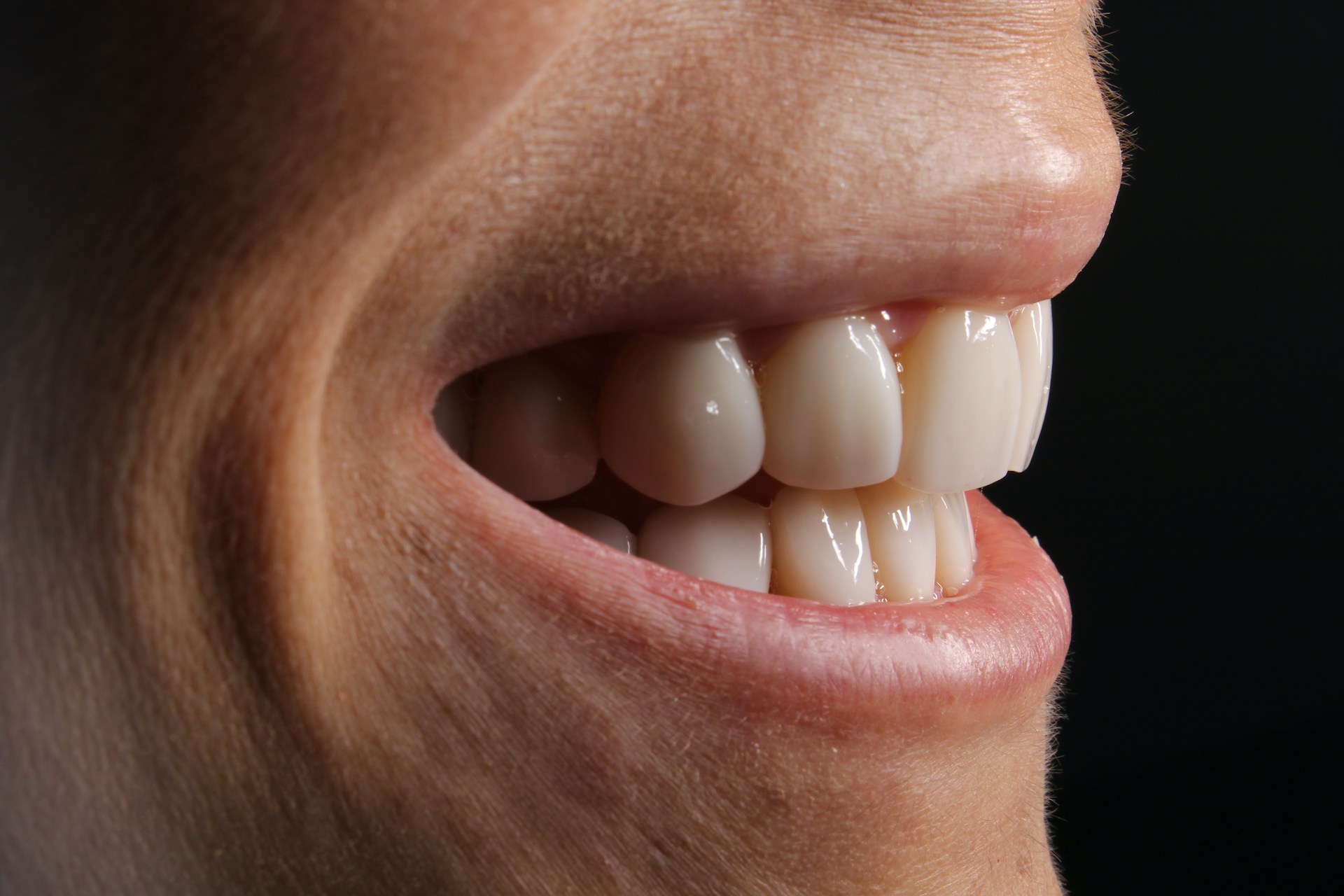 Comparaison visuelle entre différentes méthodes de blanchiment des dents, du cabinet à la pharmacie.