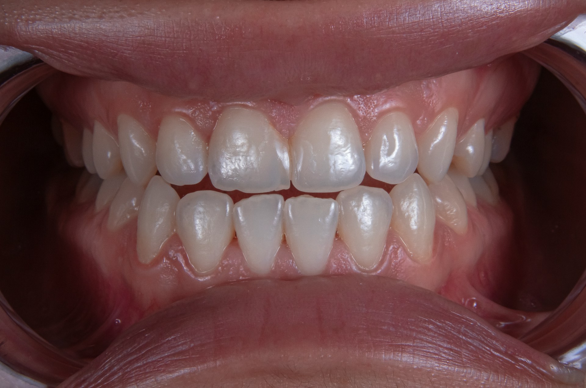 Consultation dentaire encadrant la planification d'un blanchiment des dents avec un professionnel qualifié.